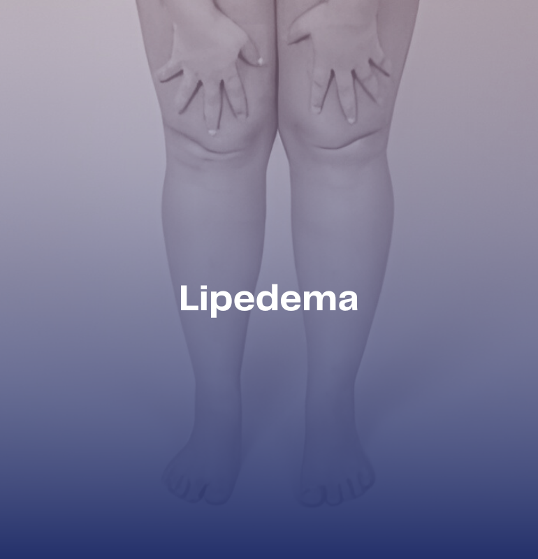 Lipedema