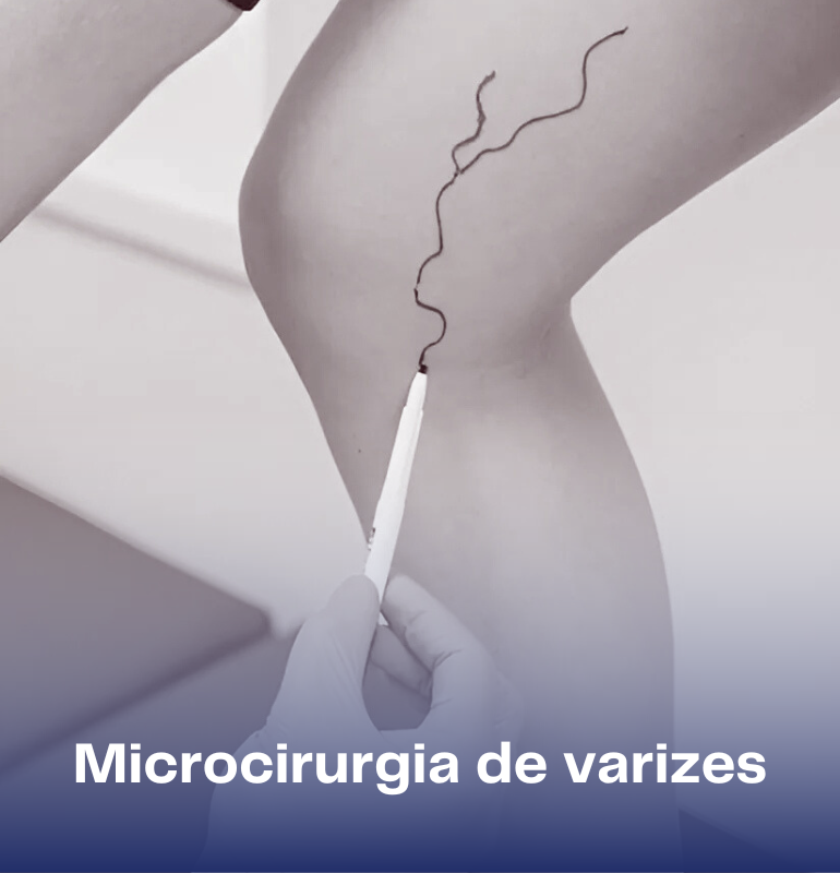 Microcirurgia de varizes