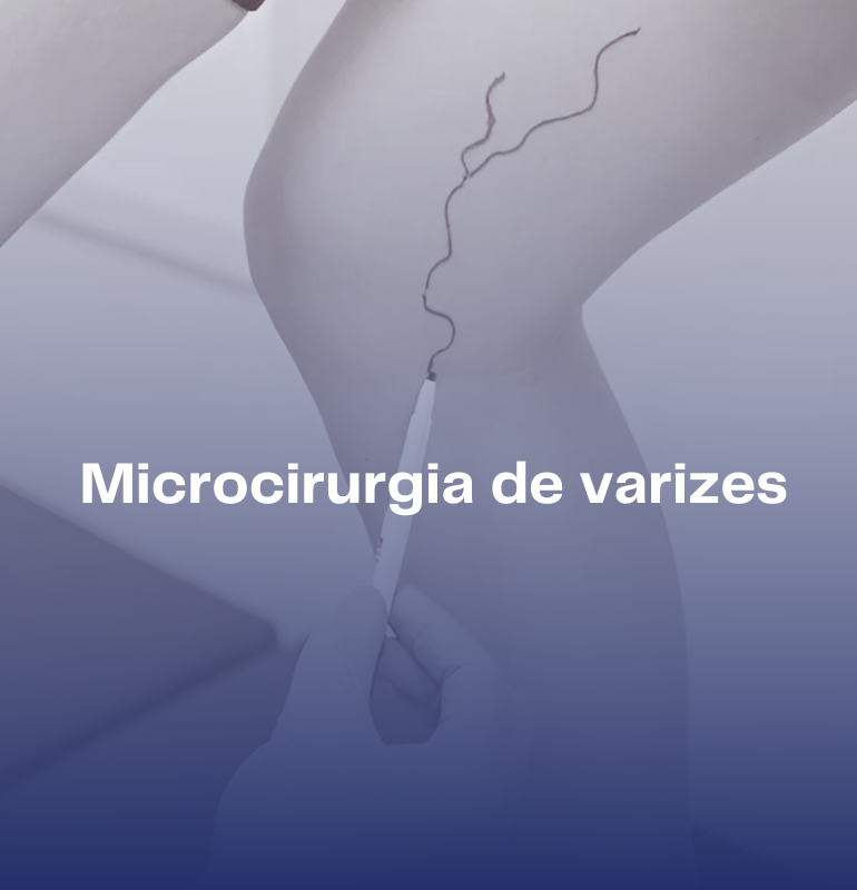 Microcirurgia de varizes