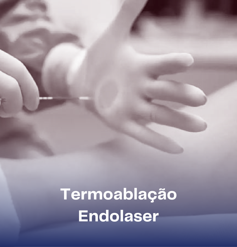 Termoablação Endolaser