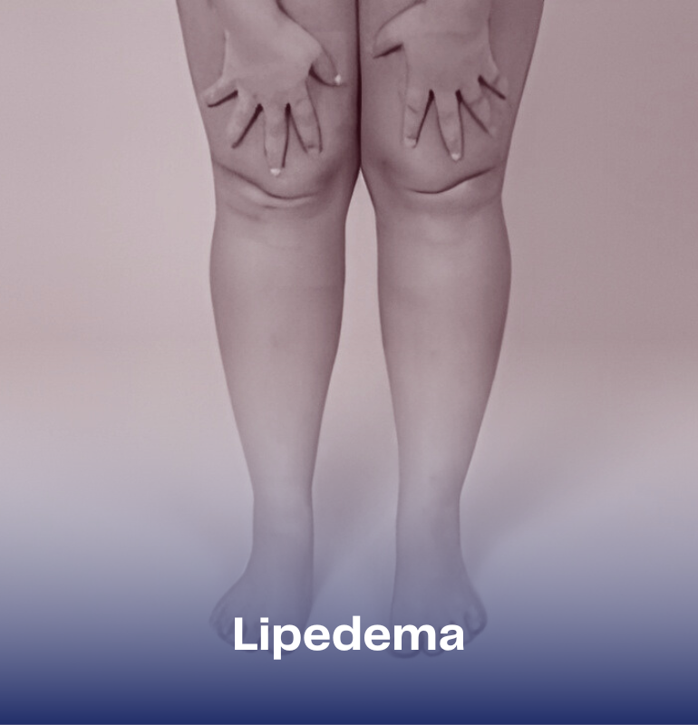 Lipedema